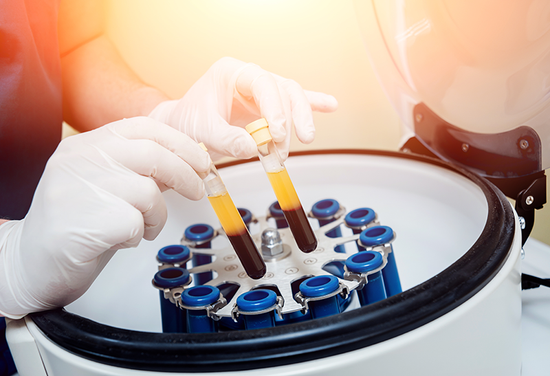 TOSM, PRP Therapy TOSM-PRP-Therapy