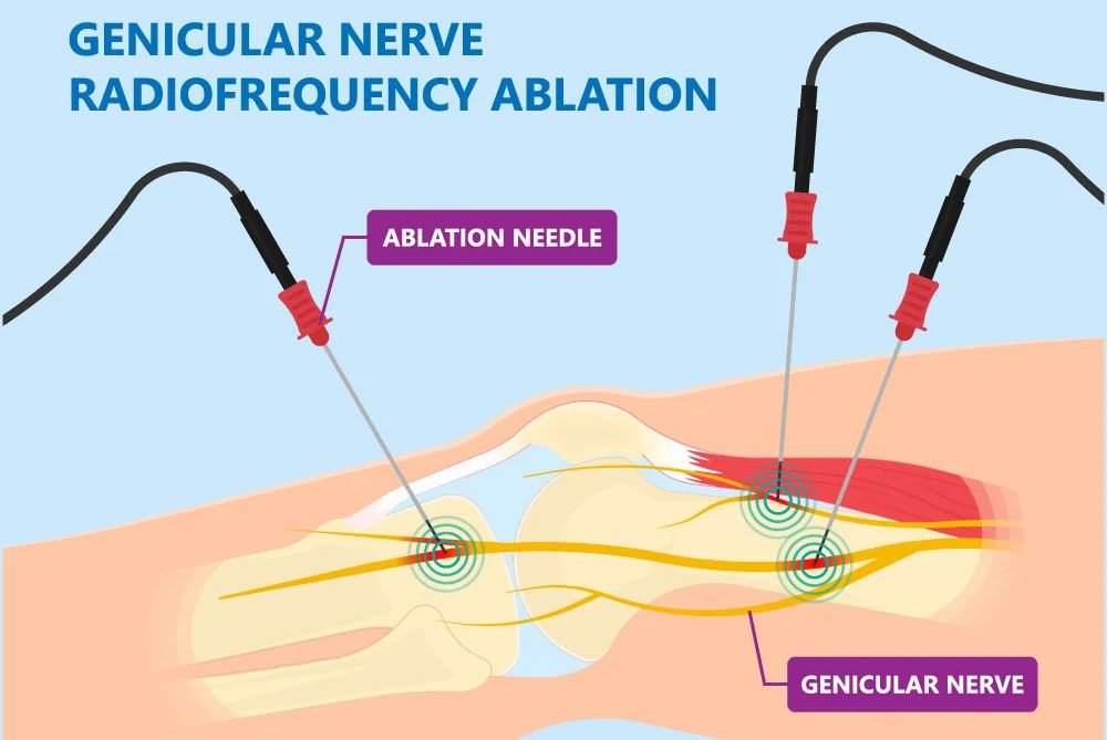 Genicular Nerve Block & Radio Frequency Ablation for Knee Pain Genicular nerve ablation for knee pain at TOSM Delray Beach