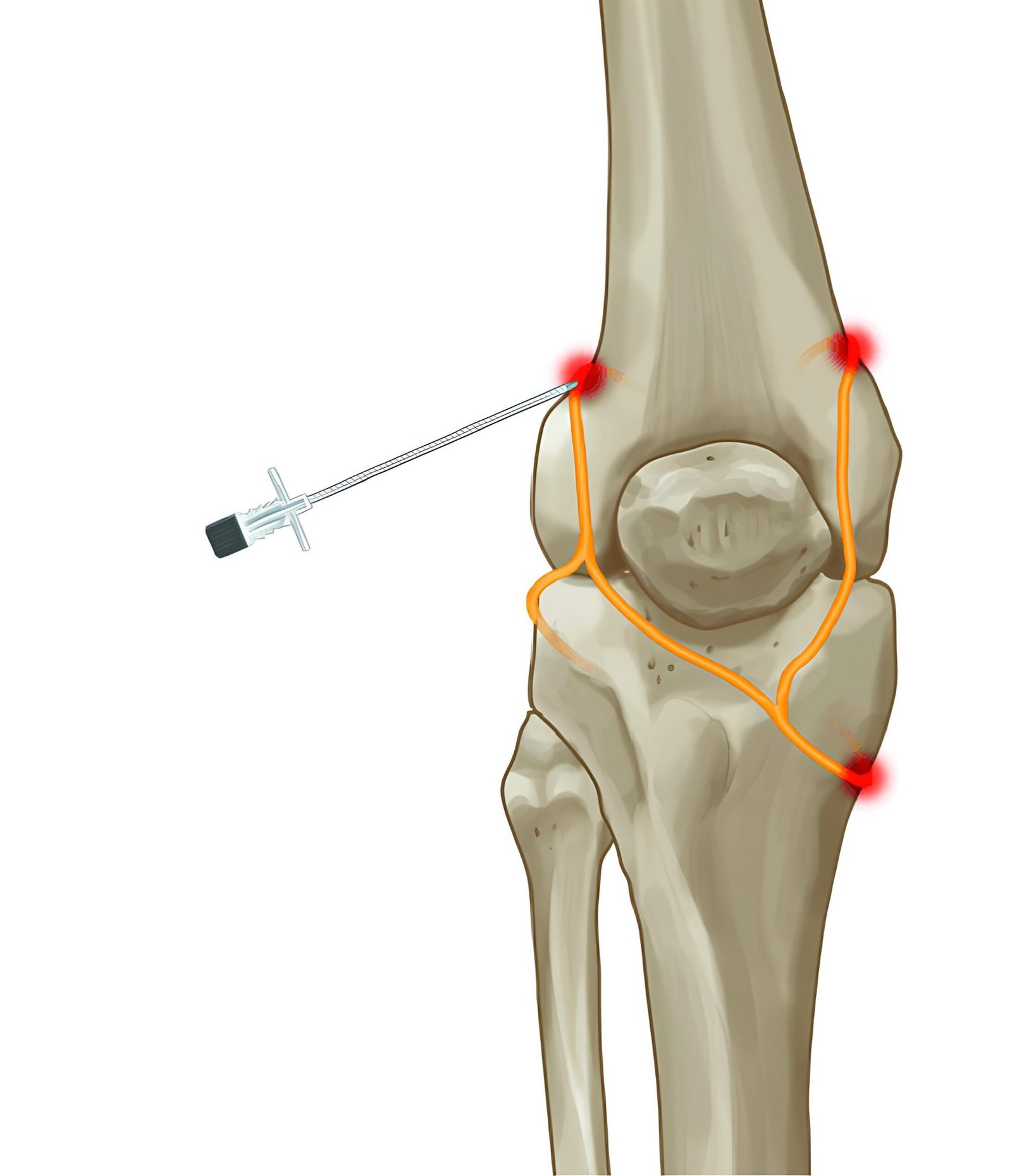 Genicular RFA for Knee Pain — Delray Beach Genicular radiofrequency ablation for chronic knee pain at TOSM, Delray Beach, FL