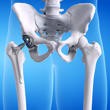 TOSM, Delray Beach, Florida, Sports Medicine, Orthopedic Doctor, Patrick Tyrance, Joint Replacements.
