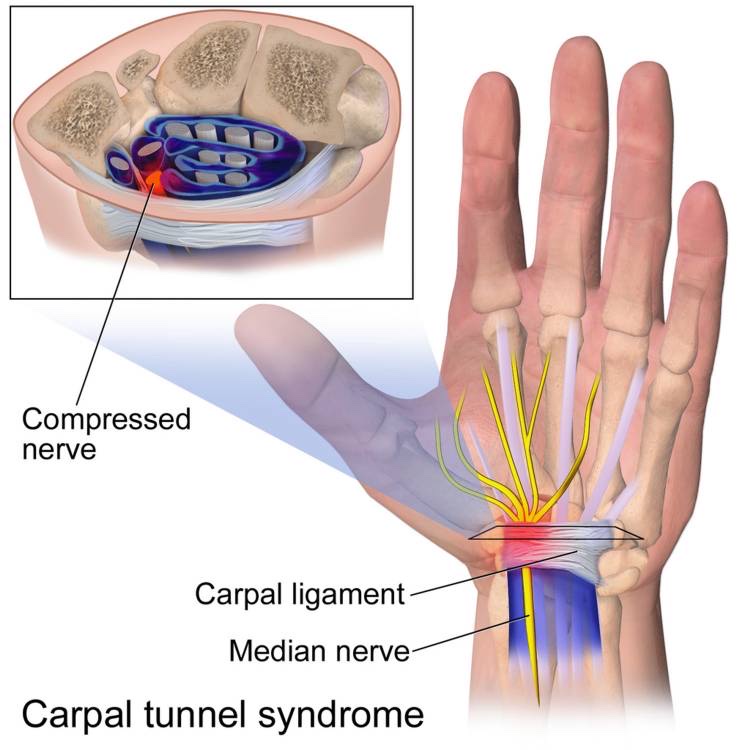Revolutionizing-Carpal-Tunnel-Treatment-Ultrasound-Guided-Release-with-WALANT