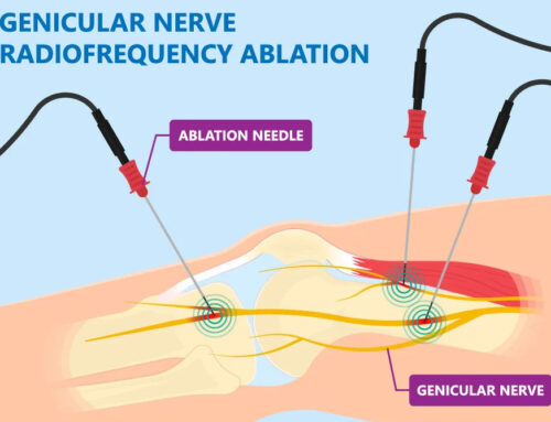 Genicular Nerve Block & Radio Frequency Ablation for Knee Pain